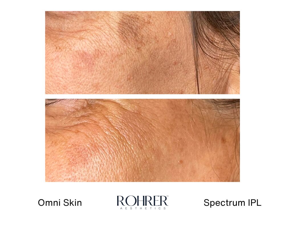 Spectrum IPL Before and After
