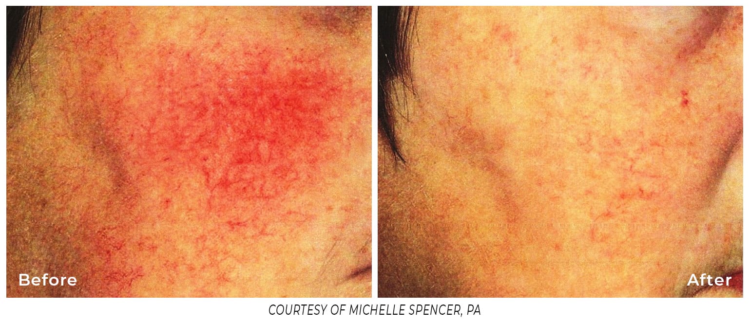 long pulsed YAG laser treatment of spider veins