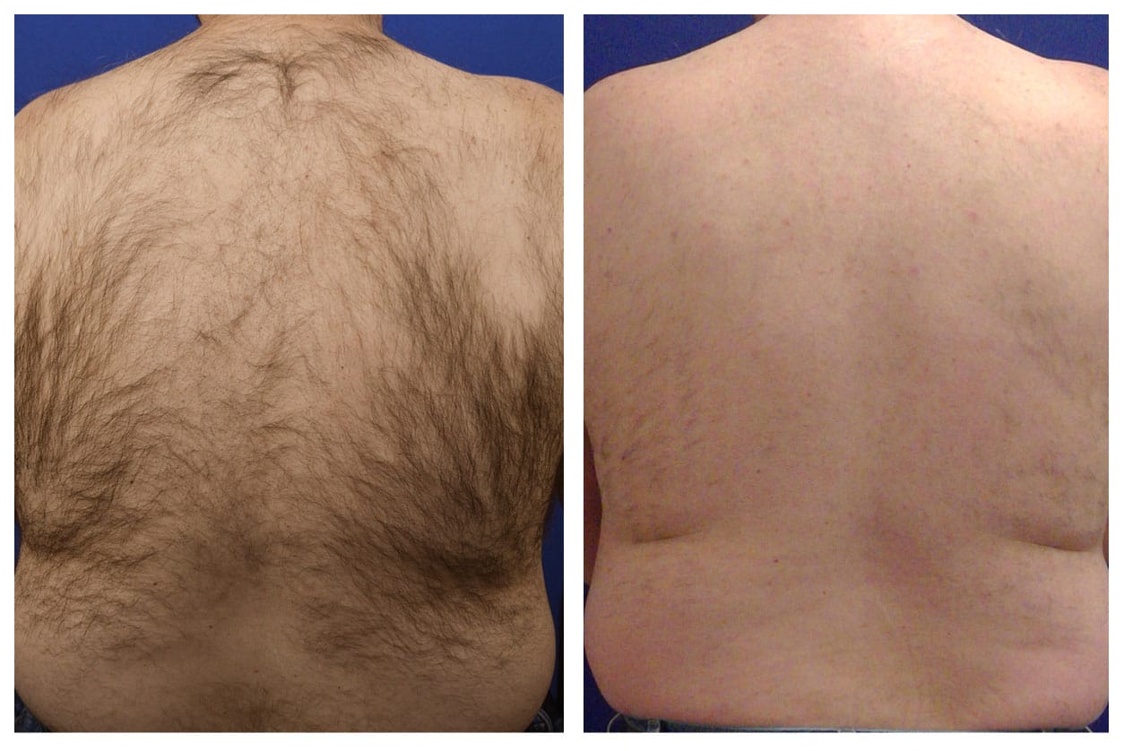 810 Hair Removal